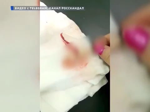 В Надыме санитарка поглумилась над оторванным пальцем пациентки