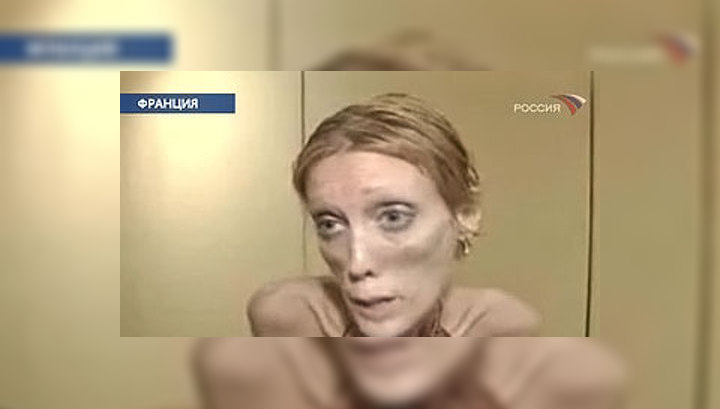 Французская модель скончалась от анорексии