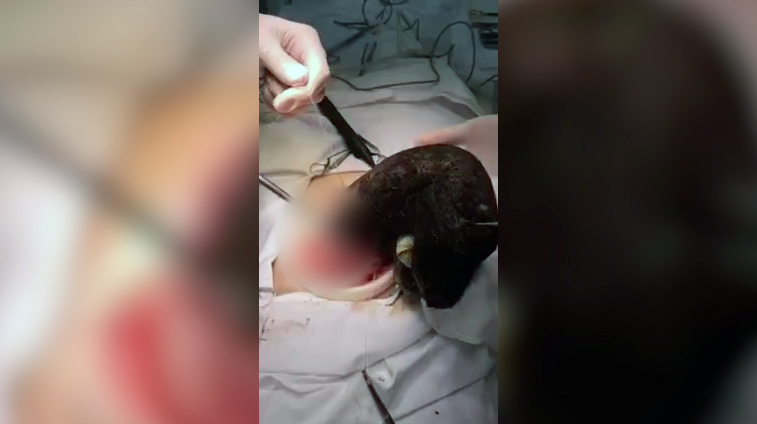 Ком волос в желудке: челябинские врачи спасли девочку с редким заболеванием