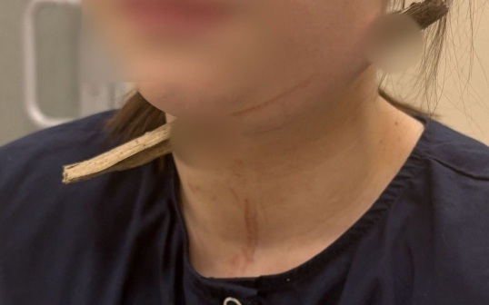В Ростове-на-Дону врачи спасли девочку, шею которой насквозь пронзила ветка