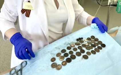 В Волгограде мужчина проглотил 217 монет, 11 гаек и 2 дверные петли