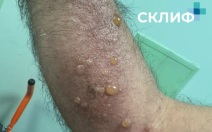 В Склиф попали пациенты, которые поднимали иммунитет борщевиком и ядом гадюки