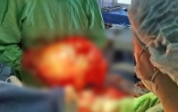 Врачи удалили петербурженке злокачественные новообразования весом более 18 кг