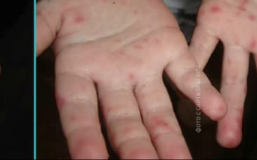 У Роспотребнадзора нет данных о вспышке заболеваемости вирусом Коксаки